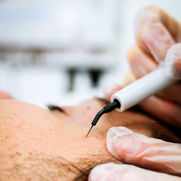 Get rid of skin tags, broken capillaries, keratosis and other skin imperfections with the hyfrecator!